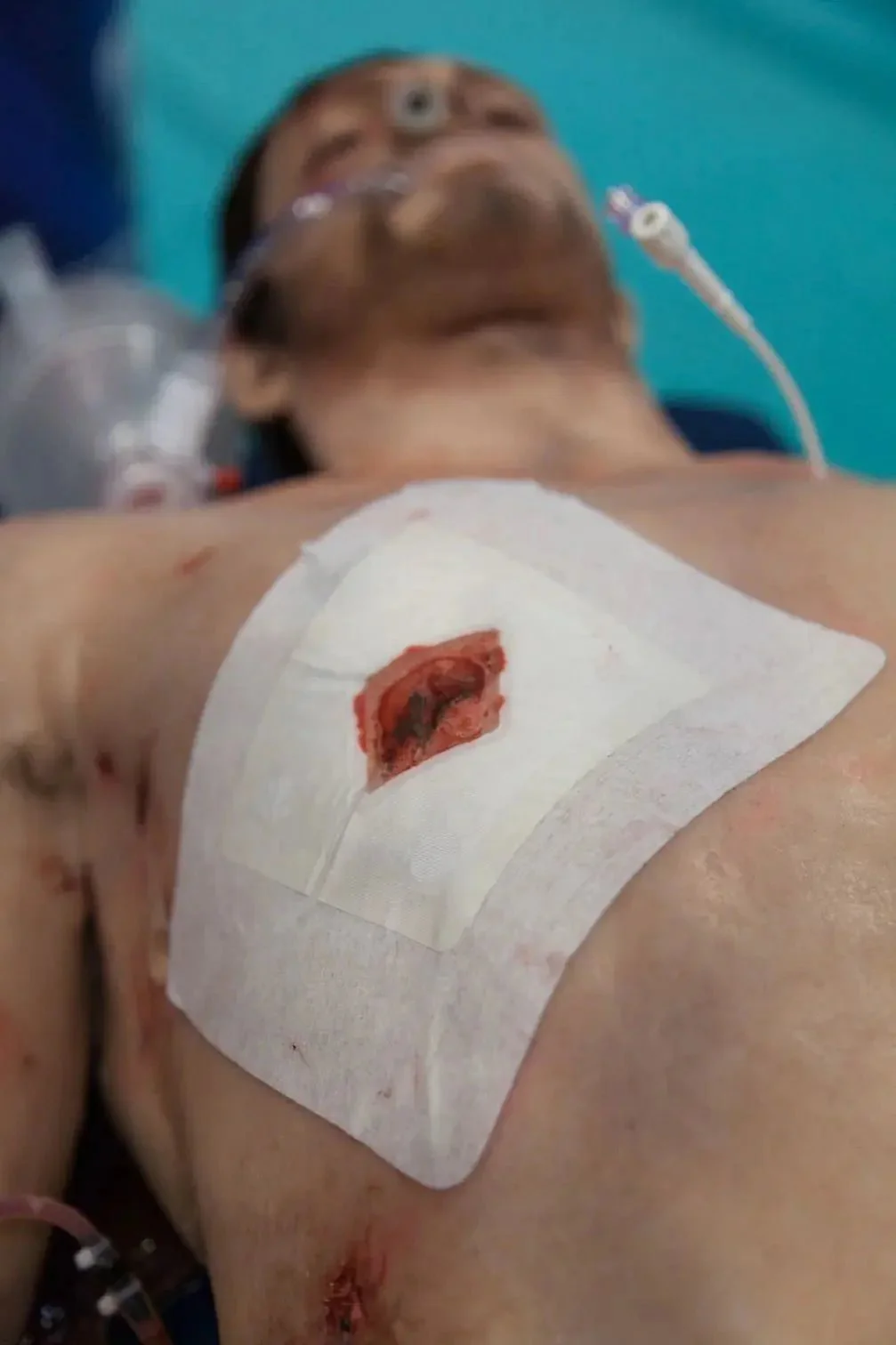 Russell Chest Seal - Image 5